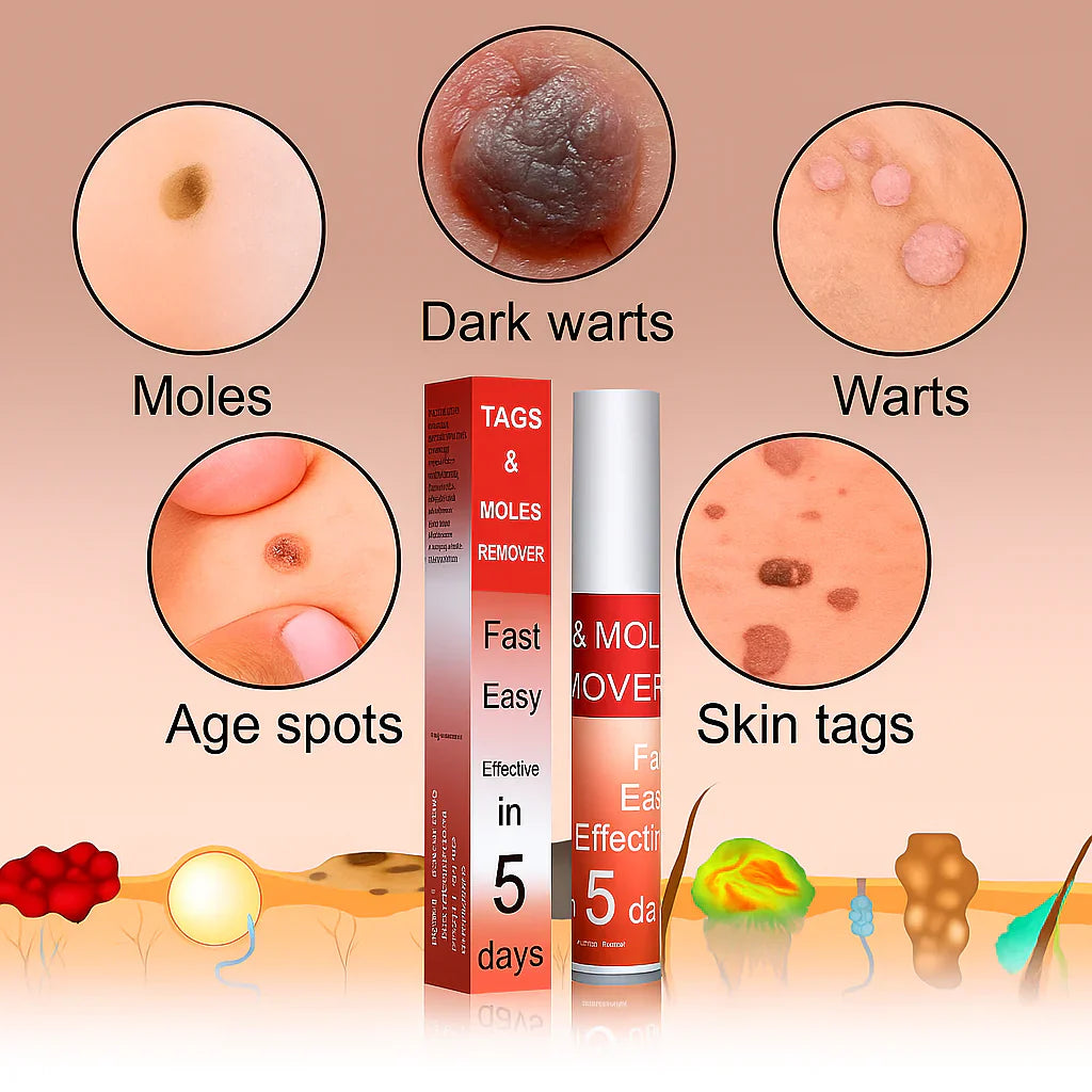 LOVILDS™ Tags & Moles Remover (Buy 1 Get 1 Free)