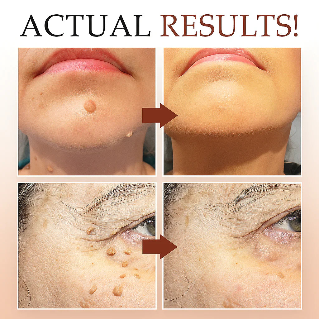 LOVILDS™ Tags & Moles Remover (Buy 1 Get 1 Free)