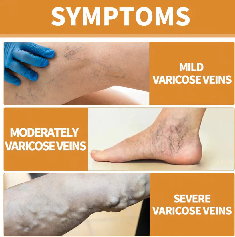 Turmeric Varicose Vein Relief Spray Buy 1 Get 1 Free